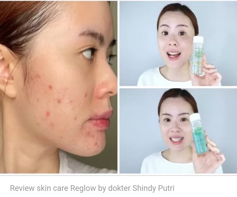 review skin care reglow by dr shindy mengatasi jerawat